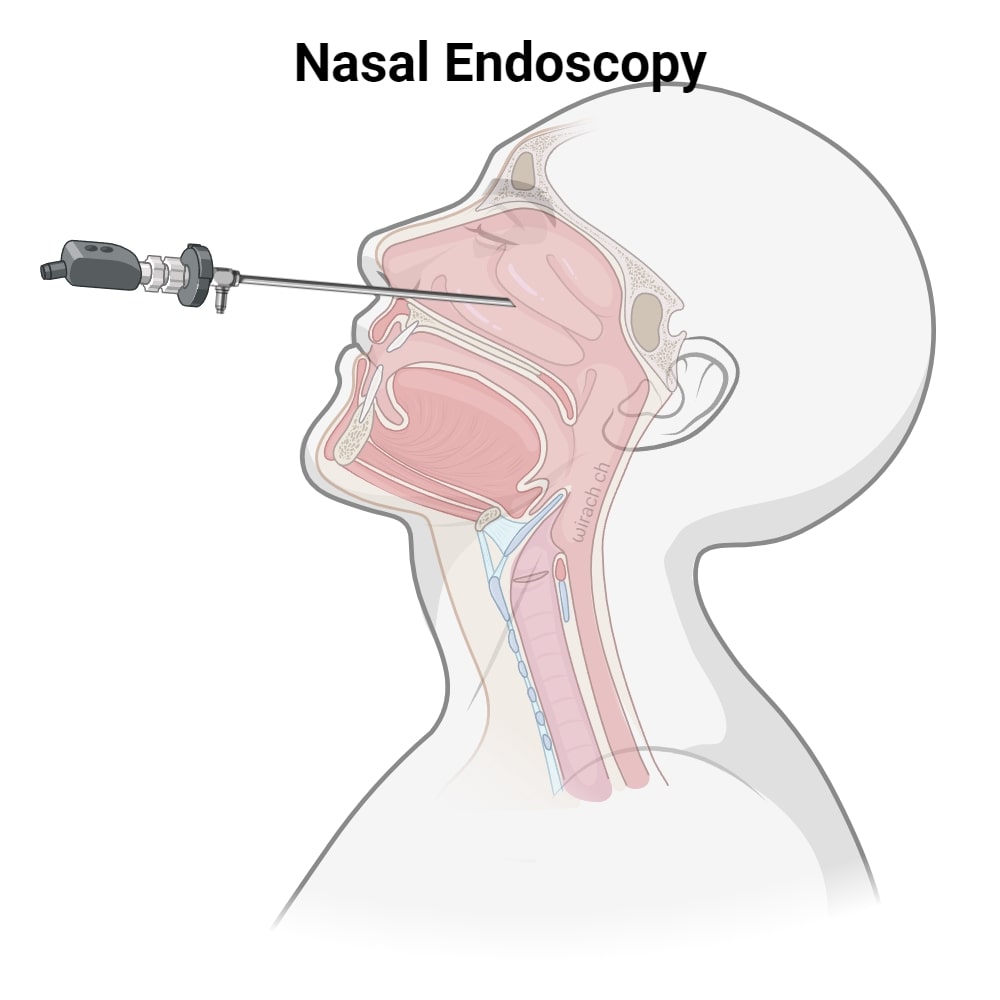 ilustrasi endoskopi hidung